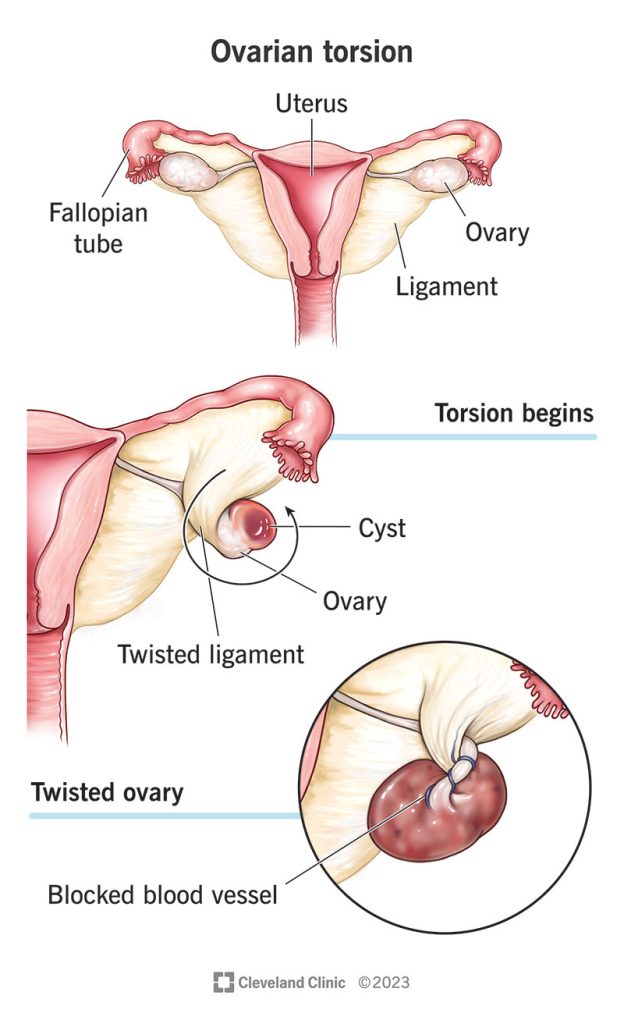 ovarian cyst