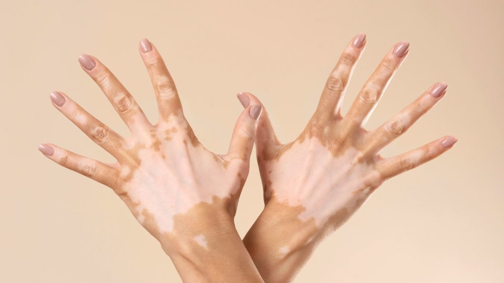 Vitiligo: Causes, Symptoms, Myths & Treatment
