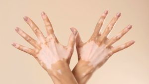 Vitiligo: Causes, Symptoms, Myths & Treatment