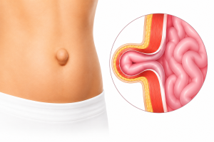 Umbilical Hernia