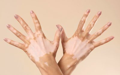 Vitiligo: Causes, Symptoms, Myths & Treatment