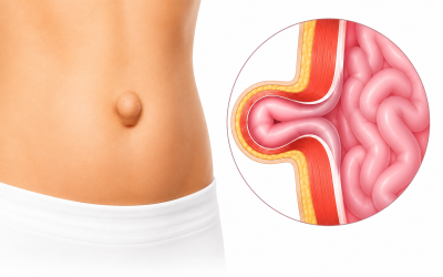 Umbilical Hernia